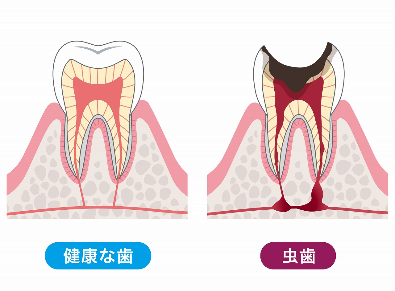 むし歯について、症状や原因について