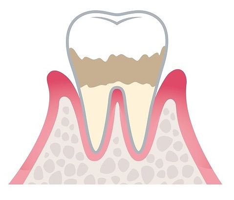 軽度の歯肉炎