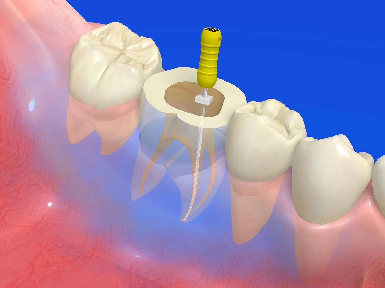 重度のむし歯のときの治療